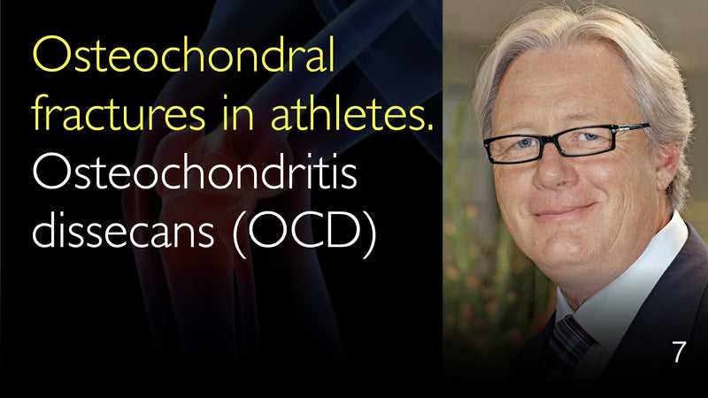 Osteochondrale fracturen bij atleten. OCS, osteochondritis dissecans. 7